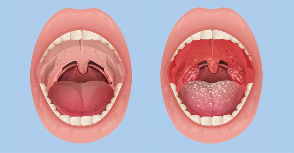 Đau họng rát cổ là tình trạng cổ họng bị sưng đỏ, đau rát và khó chịu