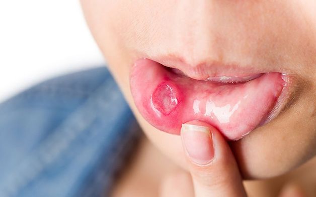 Nguyên nhân gây nhiệt miệng chưa được xác định rõ ràng, có thể do dị ứng, stress, thiếu vitamin hoặc thay đổi nội tiết tố